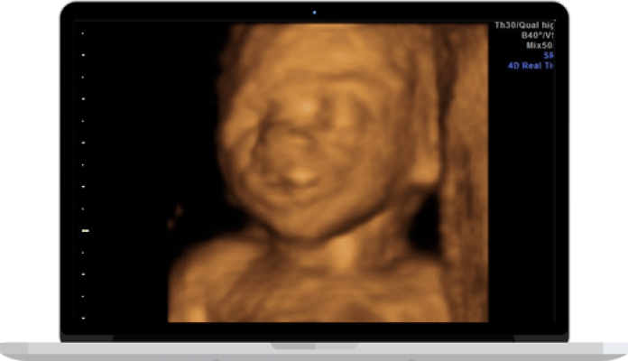 When is the best time for a 3D/4D Ultrasound?